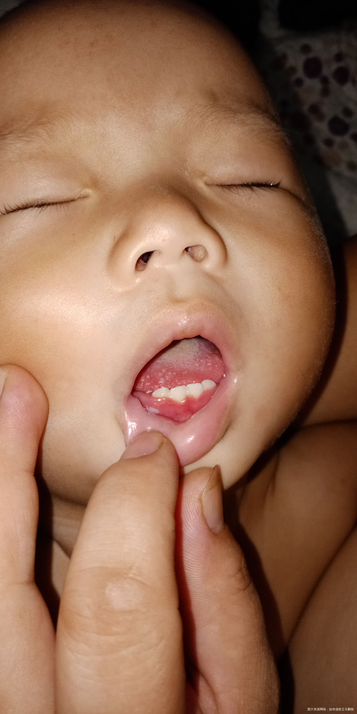 一岁女宝宝舌头上长疮。