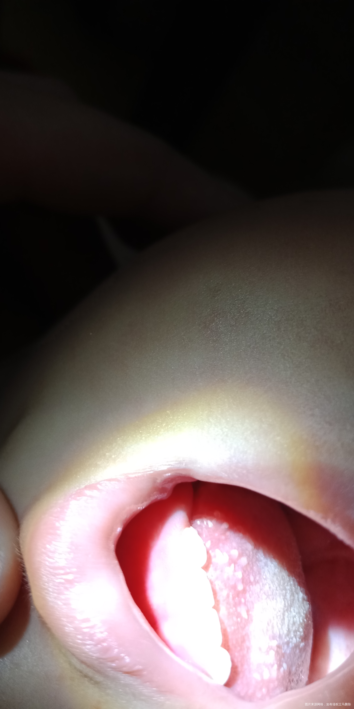 一岁女宝宝舌头上长疮。