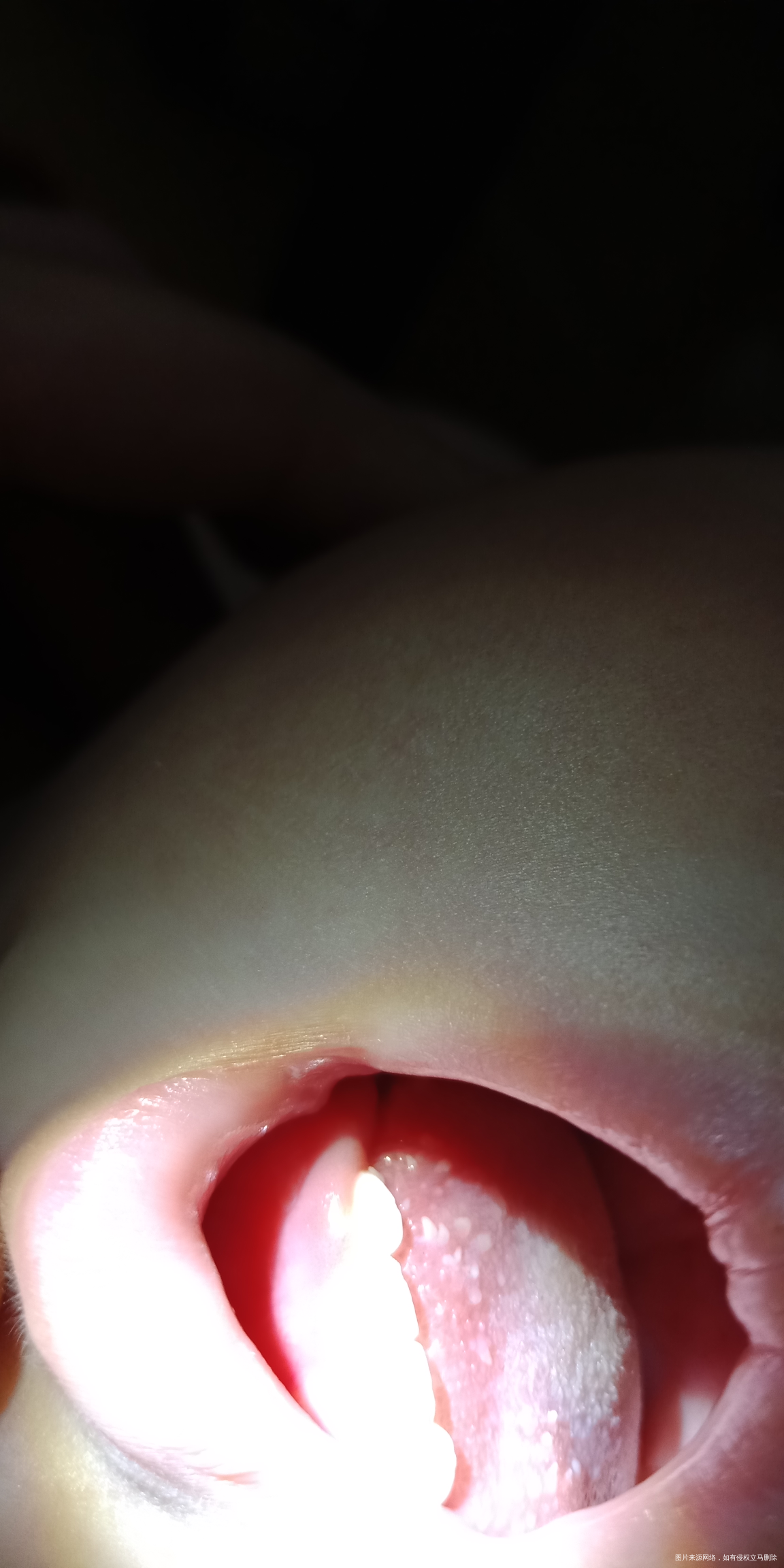 一岁女宝宝舌头上长疮。