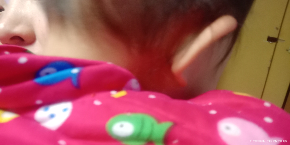 请教专家们关于过敏的问题