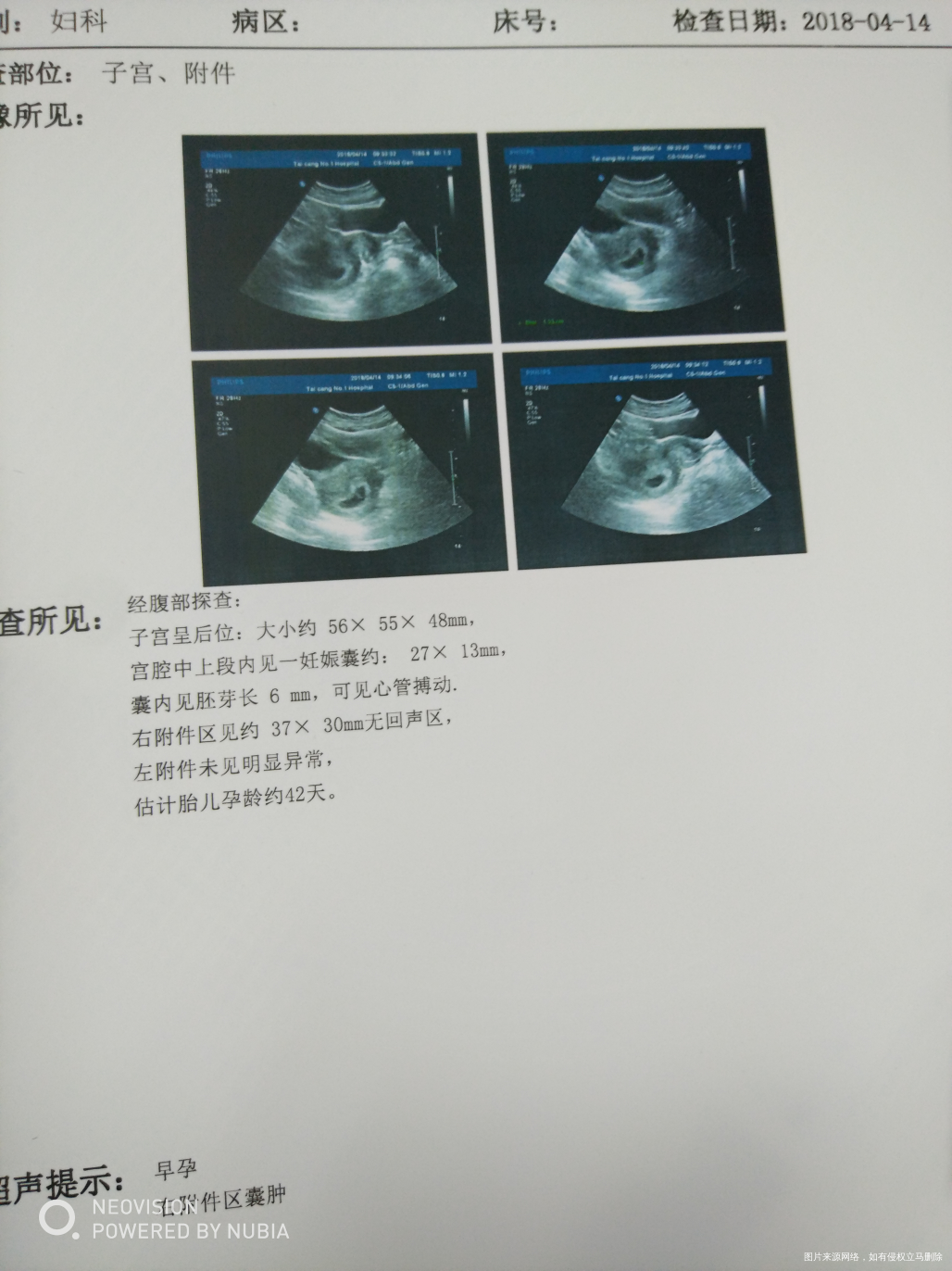 末次月经2月22号,这个b超正常吗