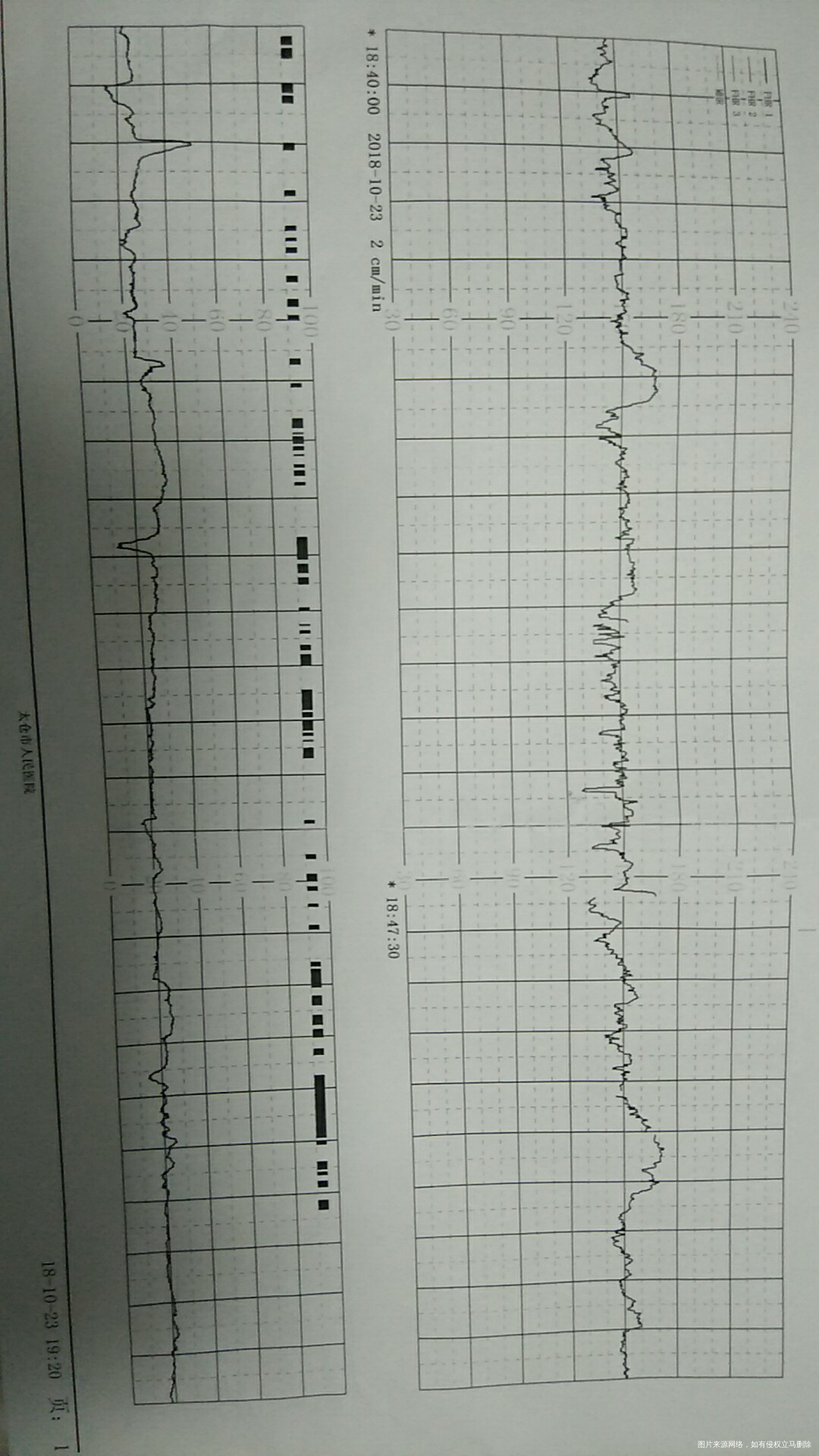 绕颈三周,这个胎心监护正常吗?
