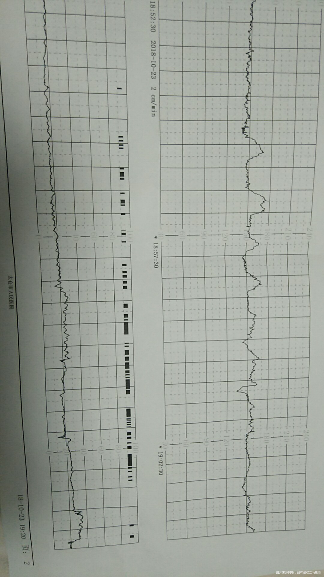 绕颈三周,这个胎心监护正常吗?