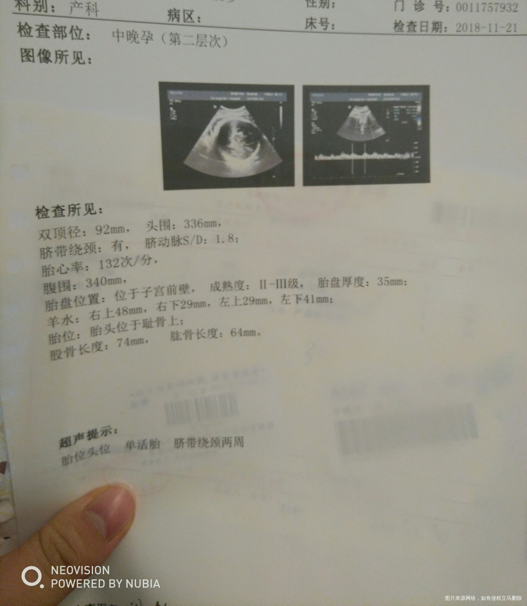 绕颈两周是否可以顺产?