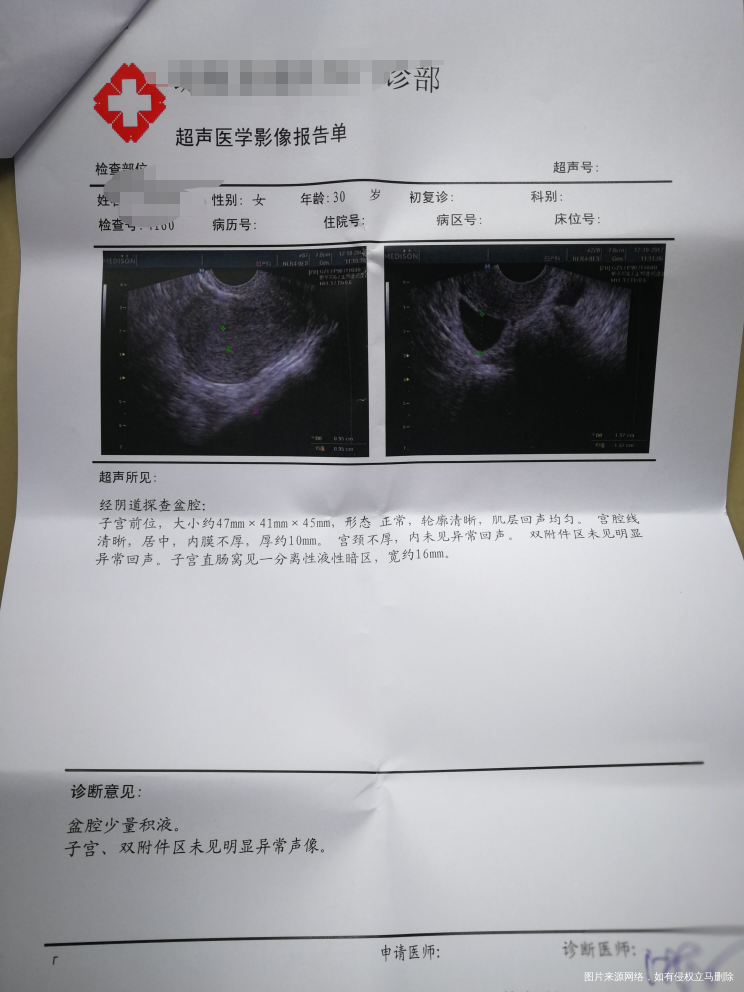盆腔积液16mm严重吗?会影响月经推迟吗?