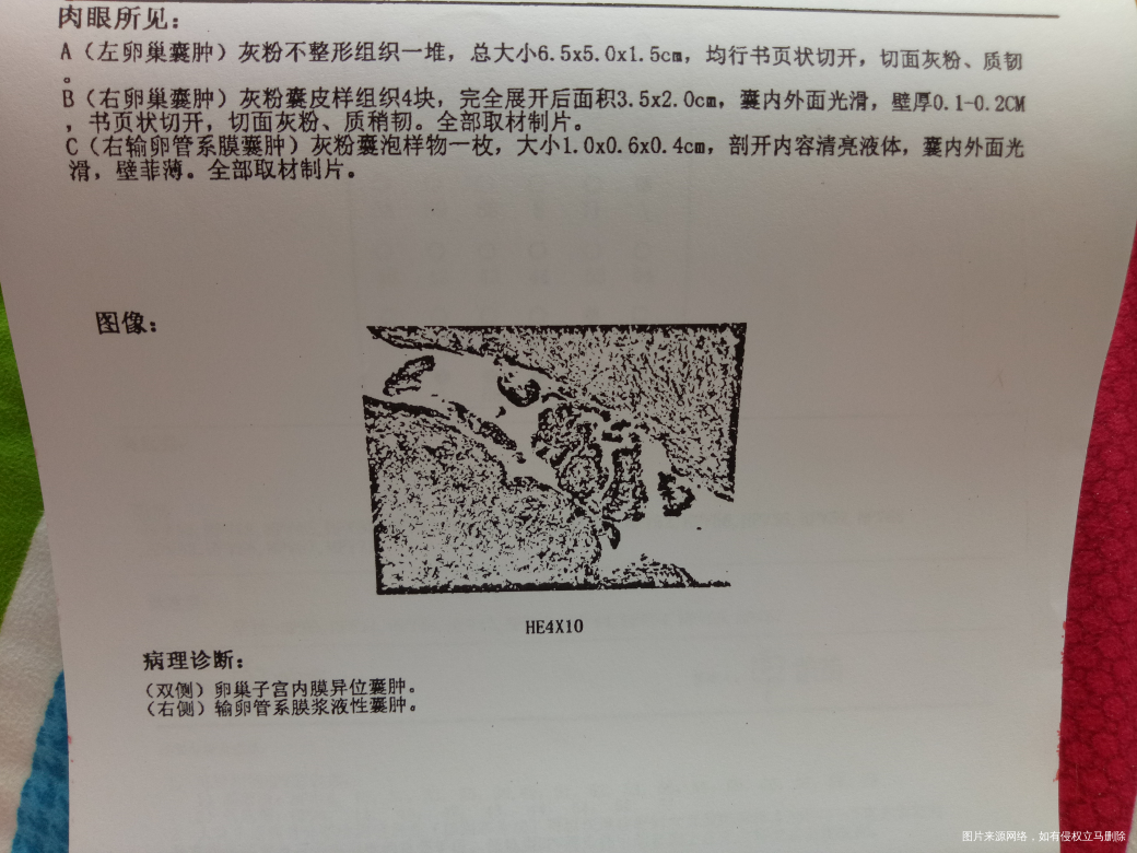 巧囊术后,该怎么保养?术前查了激素发现泌乳素高怎么办呢?详细见病历