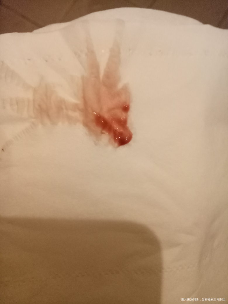 巧囊术后一月个月,打针后见红