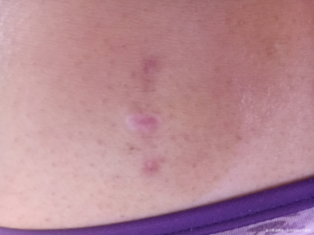 巧囊术后39天,疤碰掉伤口不太好。