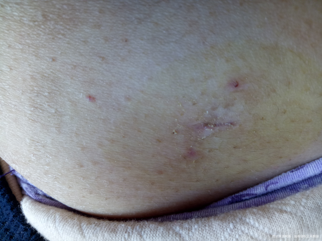 巧囊术后39天,疤碰掉伤口不太好。