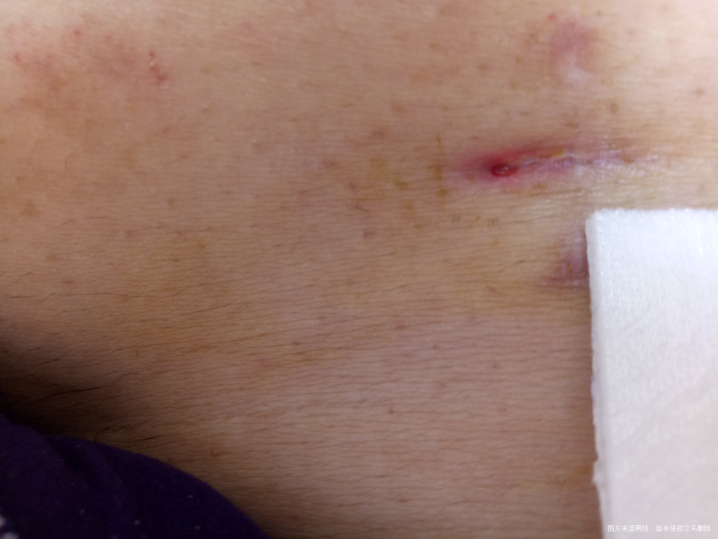 巧囊术后39天,疤碰掉伤口不太好。