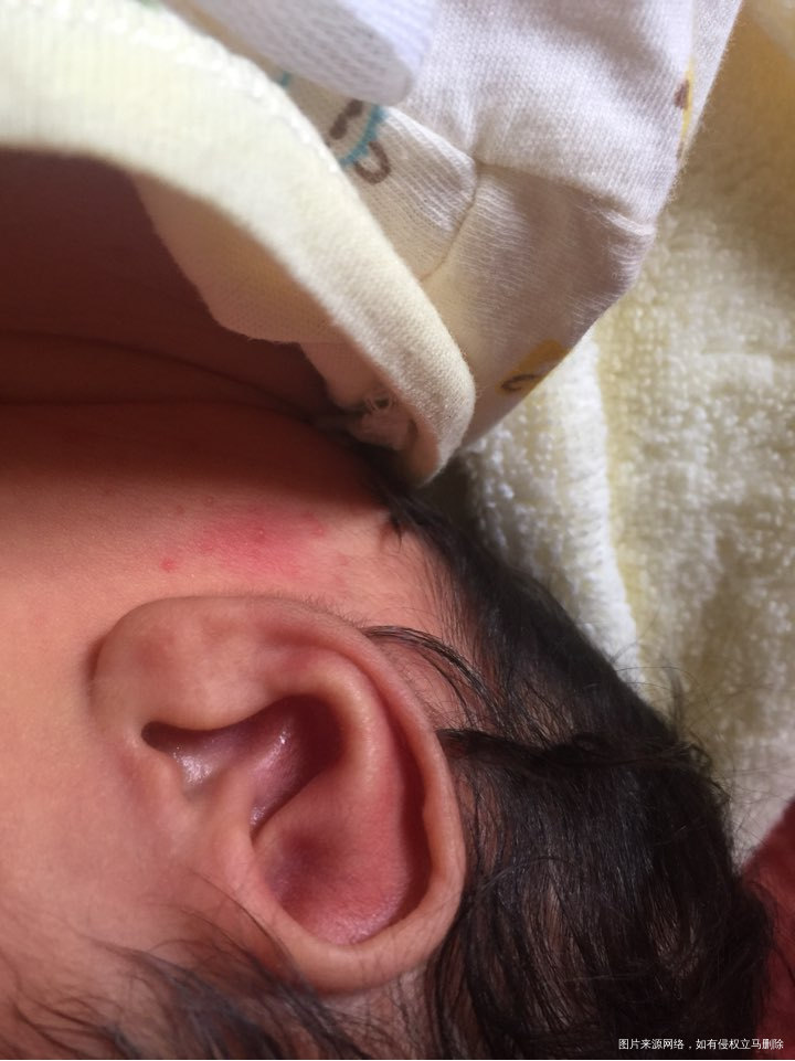 想问一下医生这个是痱子还是过敏