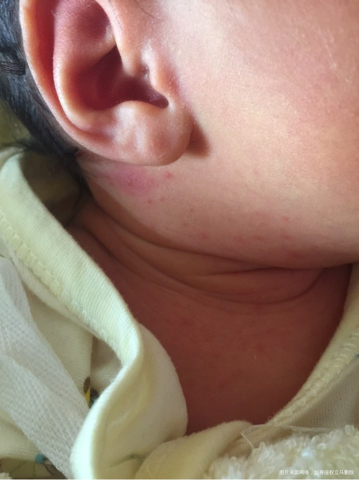 想问一下医生这个是痱子还是过敏