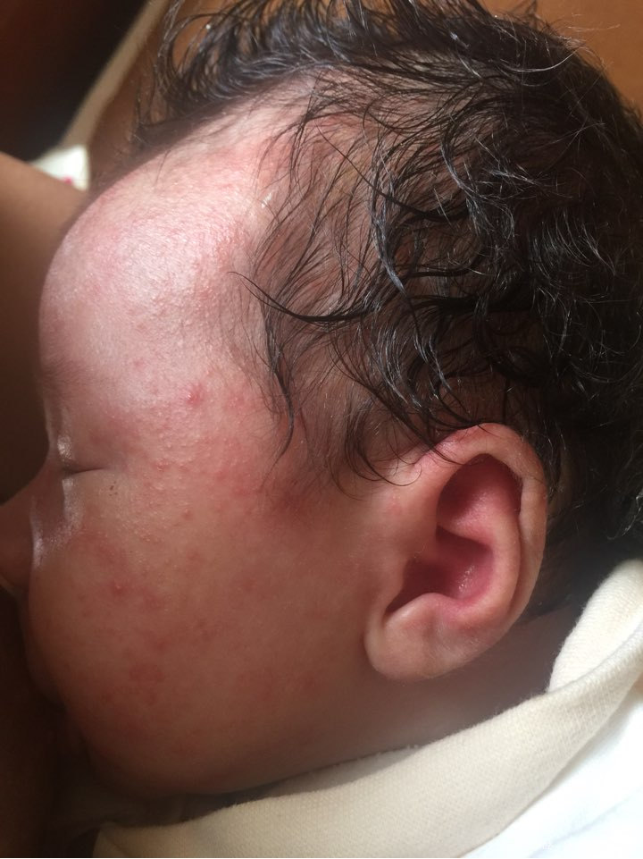 你好医生看一下这到底是湿疹,还是胎毒,每次洗完澡脸就红成这样了