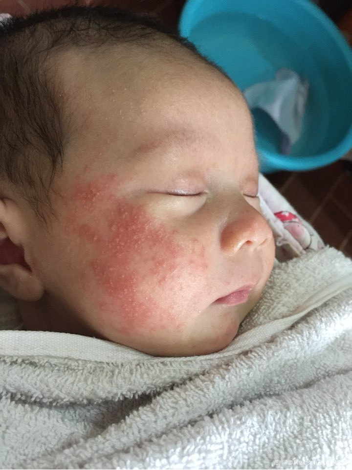 请问42天宝宝脸上这个湿疹怎么治