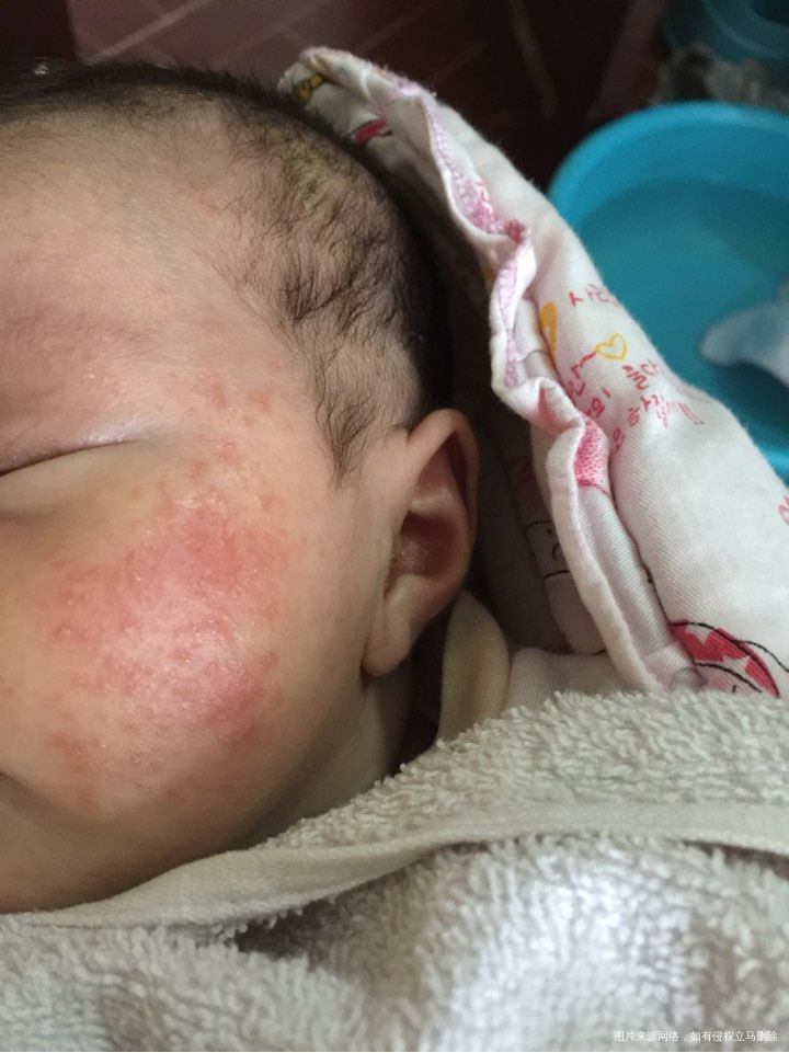 请问42天宝宝脸上这个湿疹怎么治