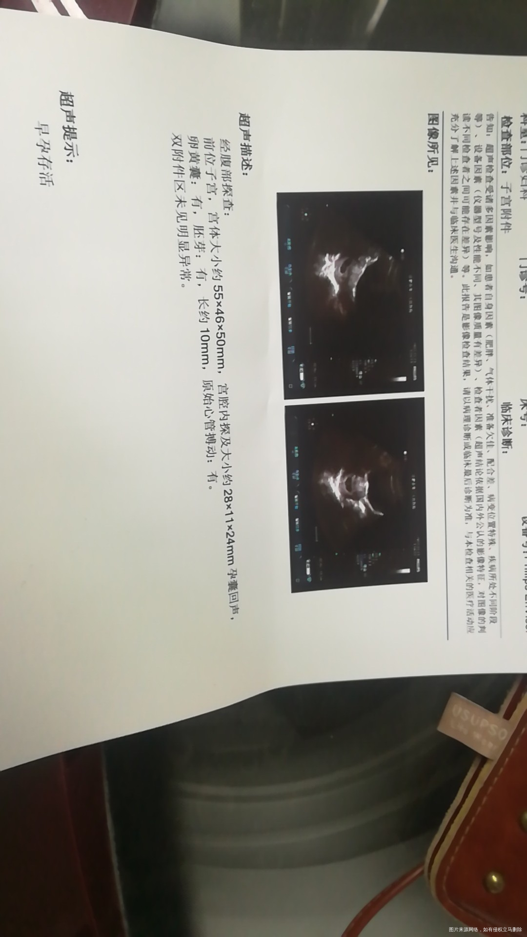 今天刚做的B超,医生帮我看看谢谢