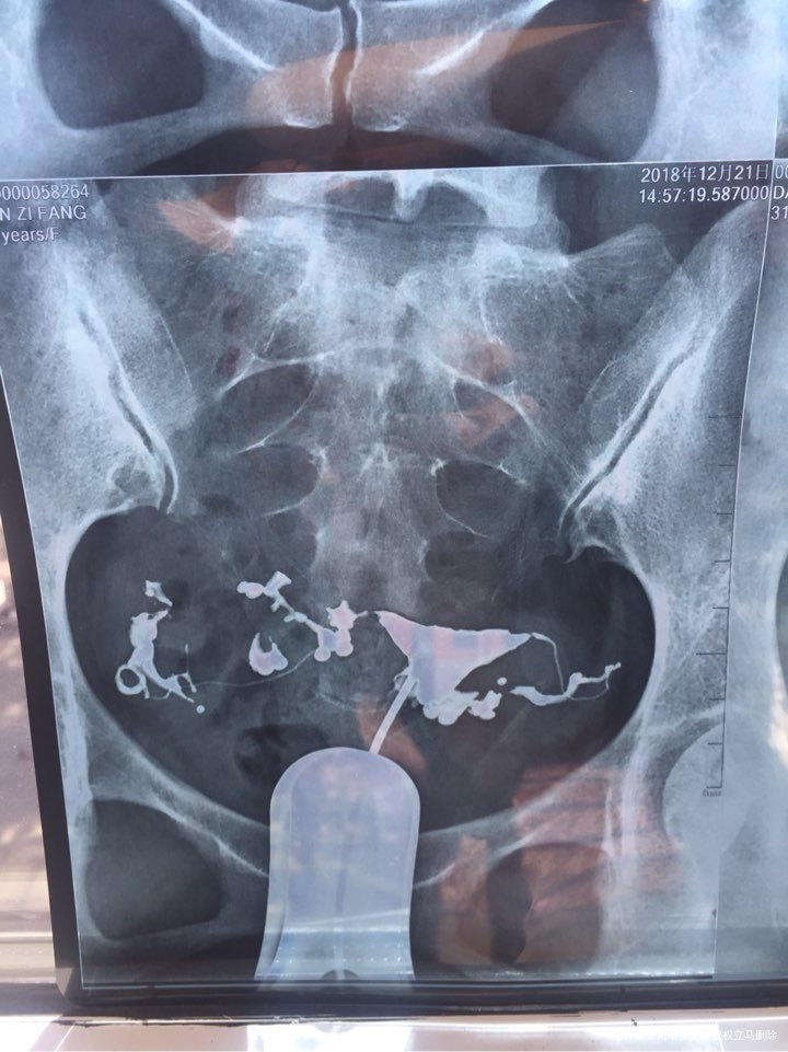 3年,为等这一天全家留下幸福的泪水
本人87金融女,配偶85军人,2014年10…