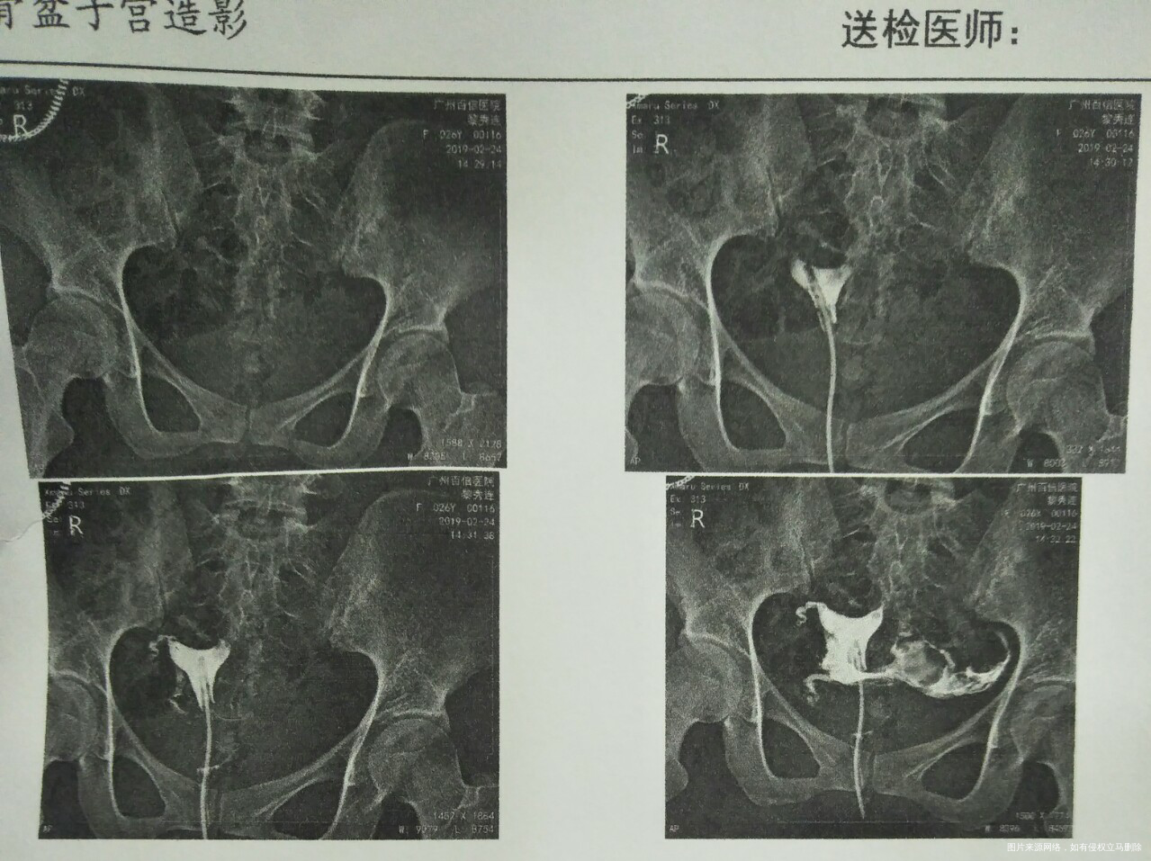 医生帮忙看看,前几天做的造影。