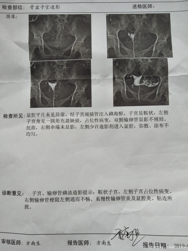 医生帮忙看看,前几天做的造影。