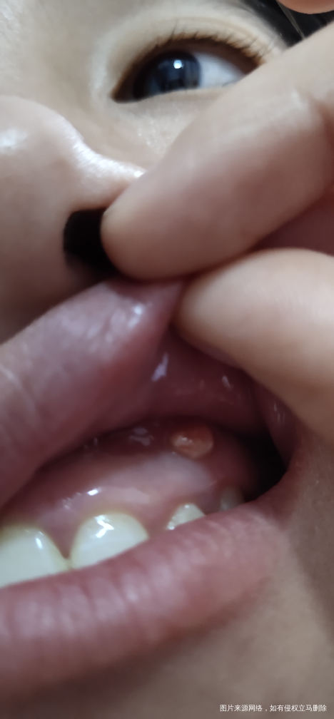 医生我嘴里牙根长了个包,去看医生医生说可能是神经炎