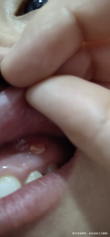 医生我嘴里牙根长了个包,去看医生医生说可能是神经炎