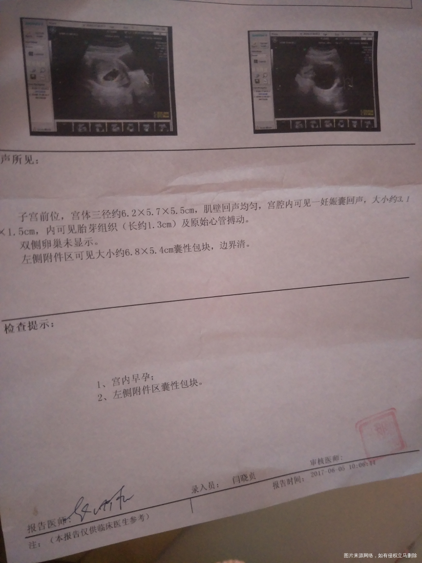 怀孕八周了,今天去医院检查做了一下B超