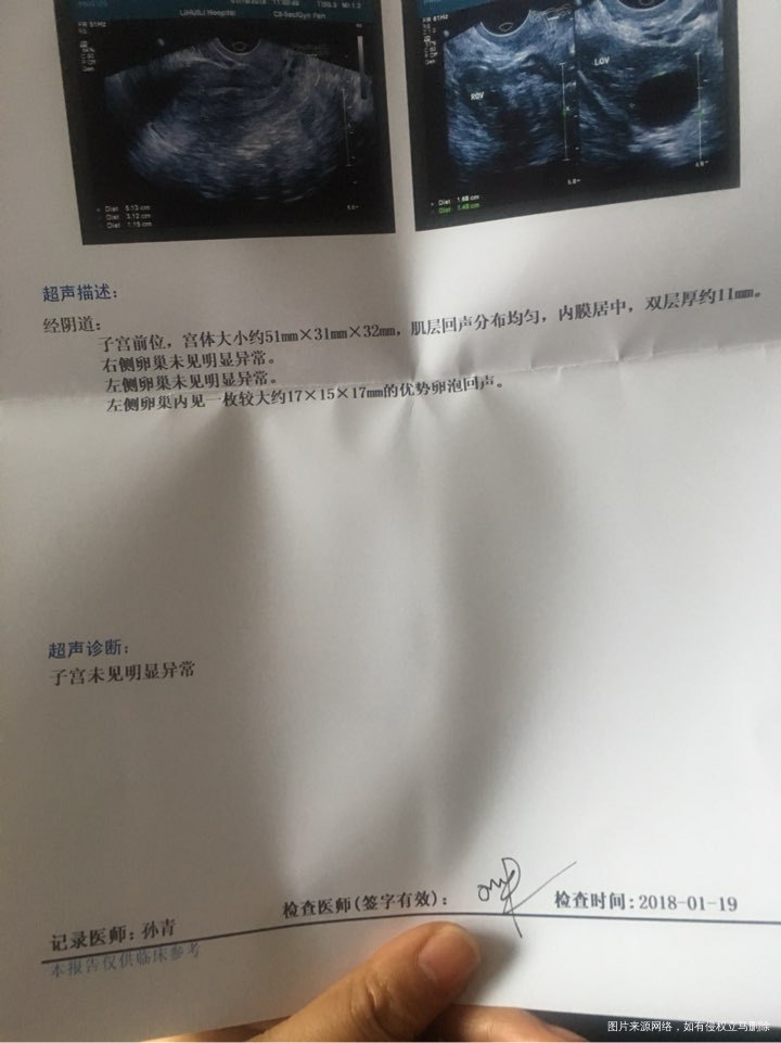 麻烦医生看月经第十七天卵泡监测