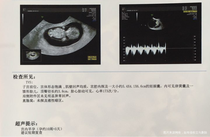 孕74天羊膜囊偏小,怎么办?
