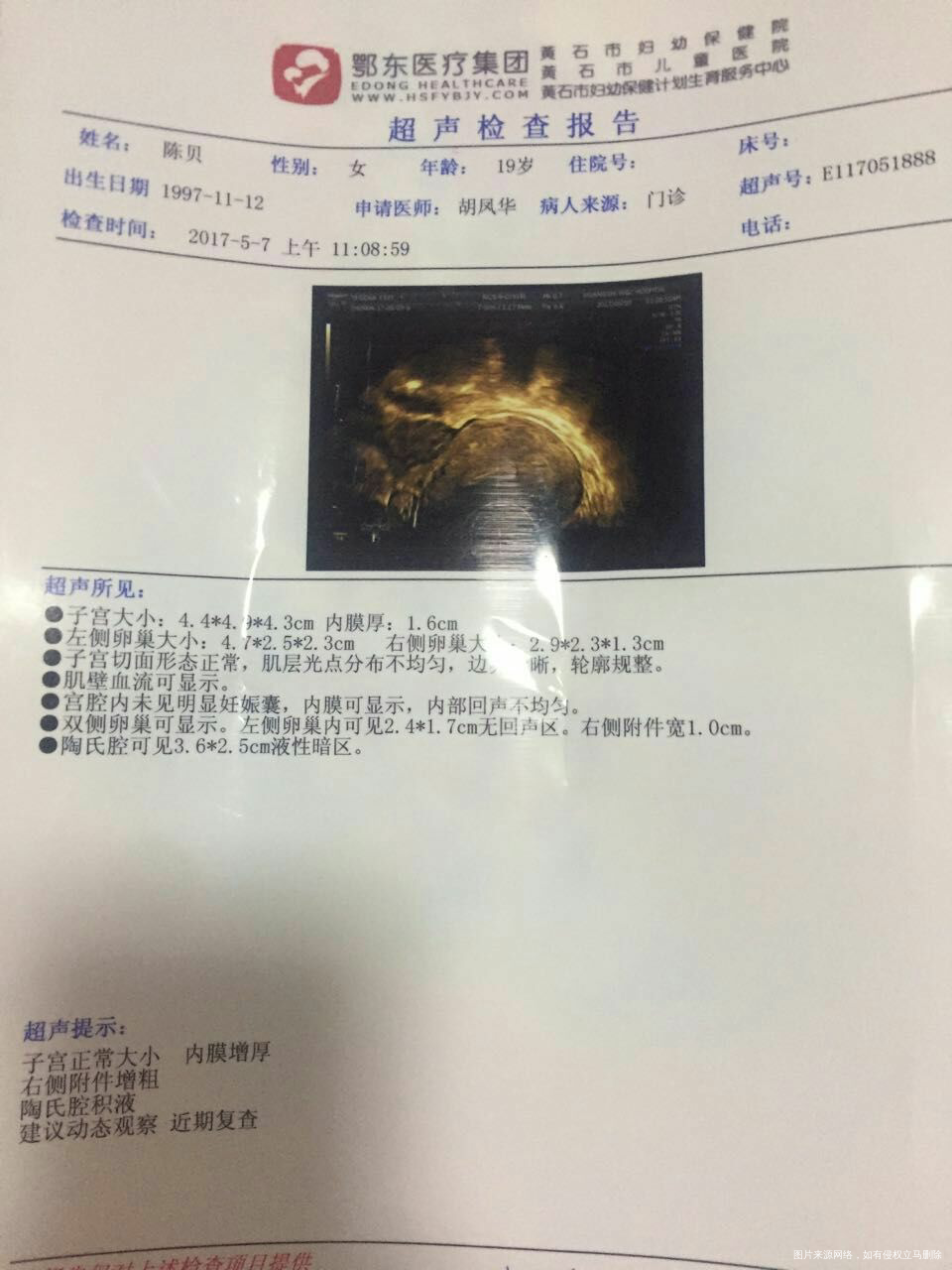 停经43天没看见孕囊 担心宫外孕 七号检查的单子 和9号的