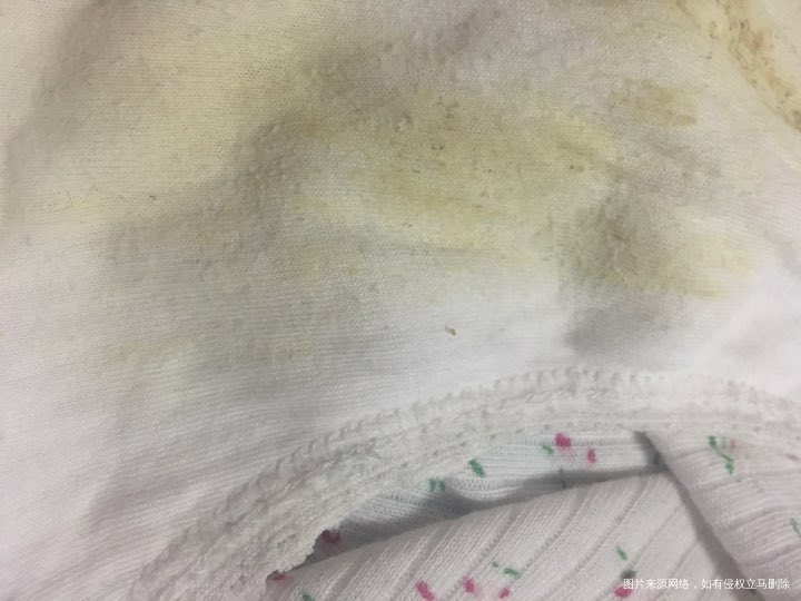 请问 医生 孕21+3 白带发黄 有一段时间了 无异味 需要检查吗 对胎儿有影响吗