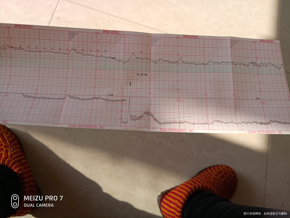第一张是吸氧之前的,第二张是吸氧之后的胎心监护,医生看看高不高?需要住院吗?