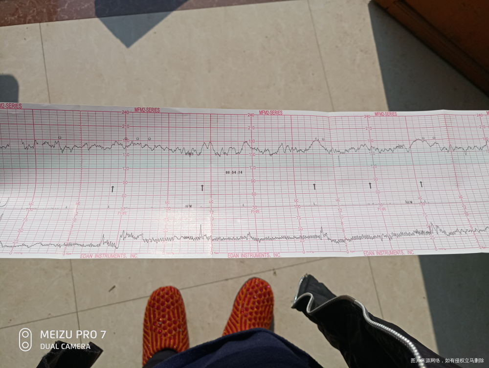 第一张是吸氧之前的,第二张是吸氧之后的胎心监护,医生看看高不高?需要住院吗?