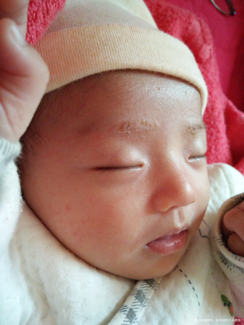 宝宝湿疹半个月了,这药可以用吗?