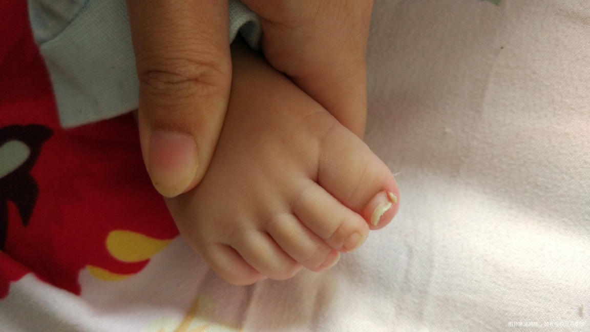 帮忙看看宝宝脚指甲怎么回事?