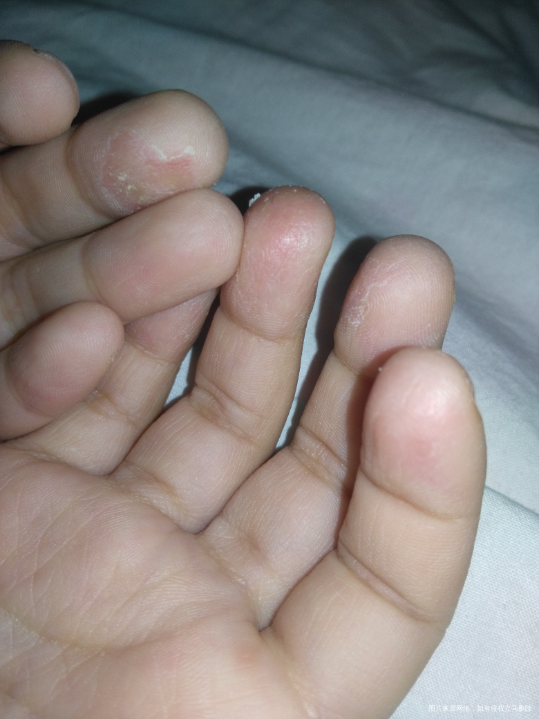 姐妹们,帮忙看看,孩子手指肚爆皮怎么回事?