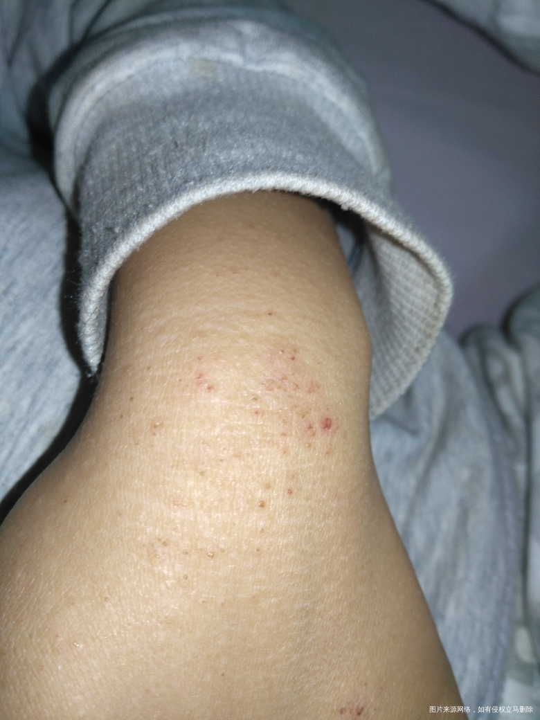 孩子湿疹反反复复,以前用北京儿研所的硅霜,肤乐霜