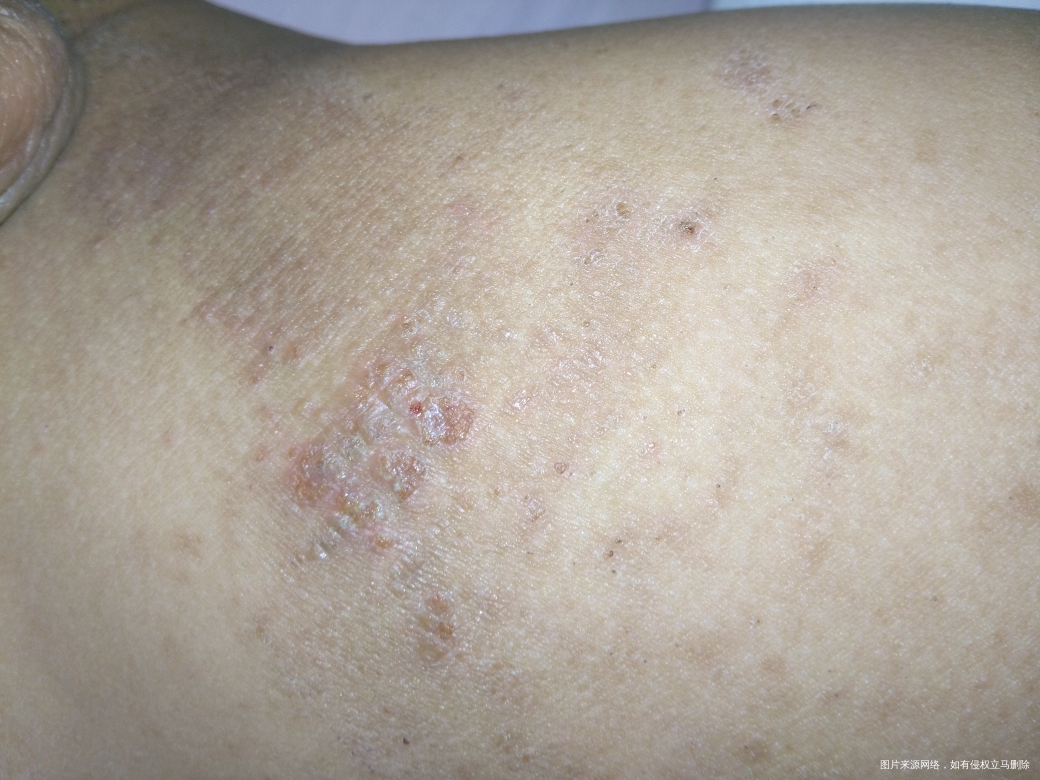 孩子湿疹反反复复,以前用北京儿研所的硅霜,肤乐霜