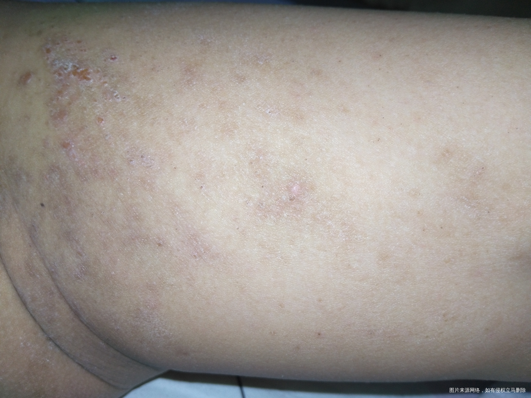 孩子湿疹反反复复,以前用北京儿研所的硅霜,肤乐霜