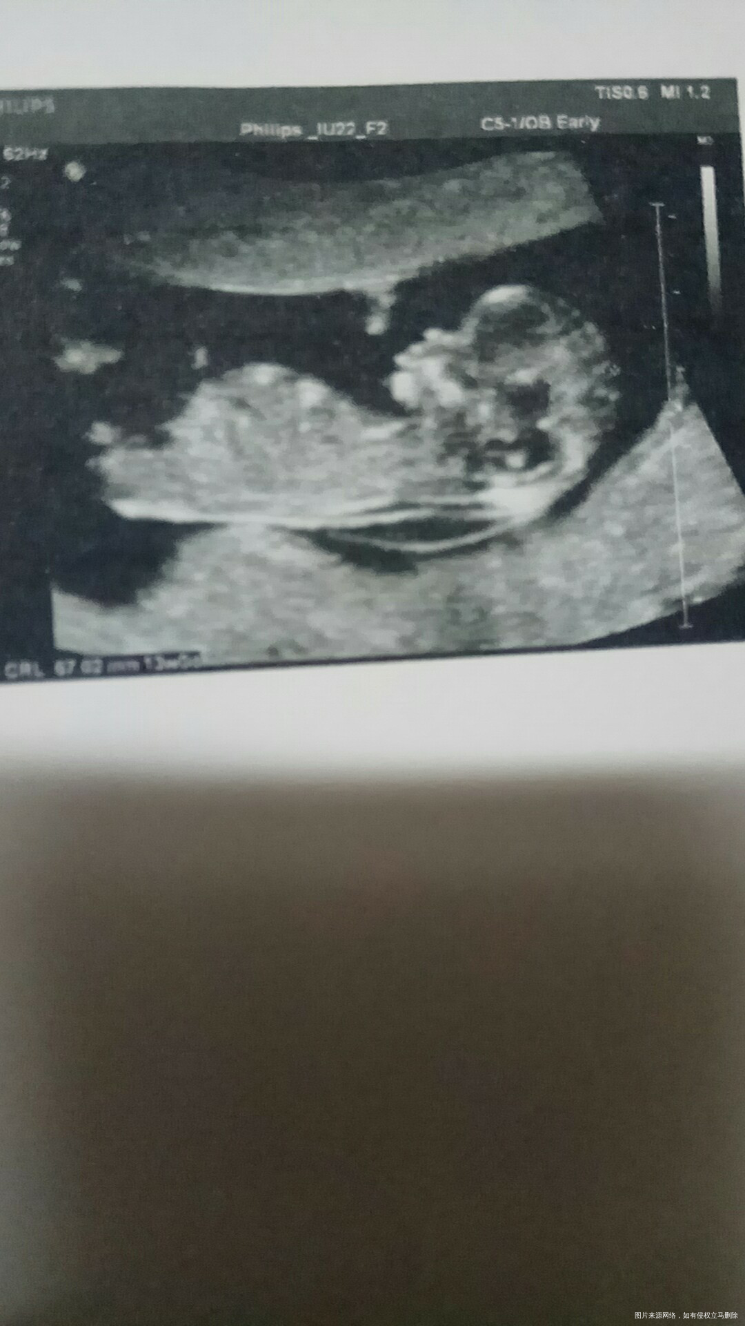 
12月14号顺利通过nt✌宝宝很乖,nt一次通过,看到小可爱的模样,瞬间觉得…