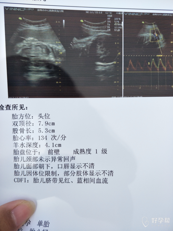 股骨短.代表胎儿个子也矮么?