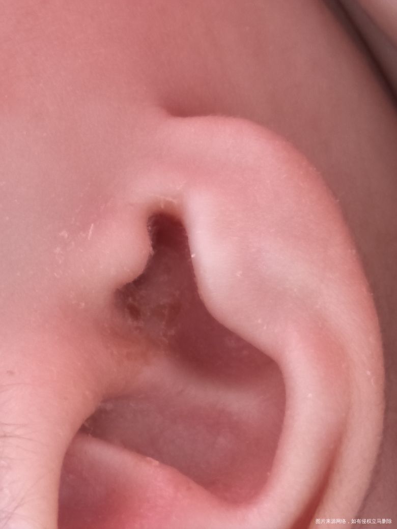 大夫给看看是湿疹吗?还出水