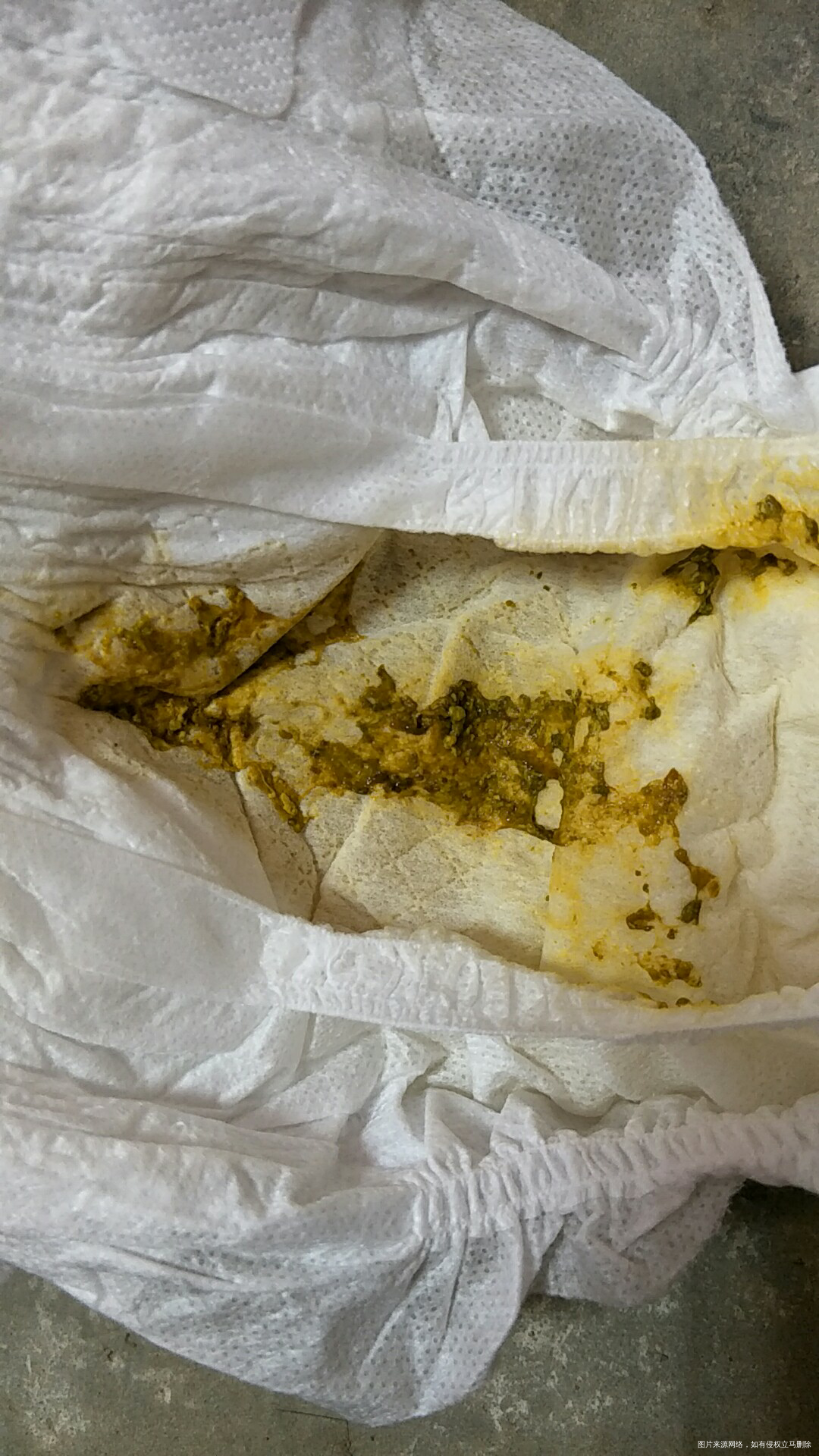 宝宝拉这样的粑粑正常吗