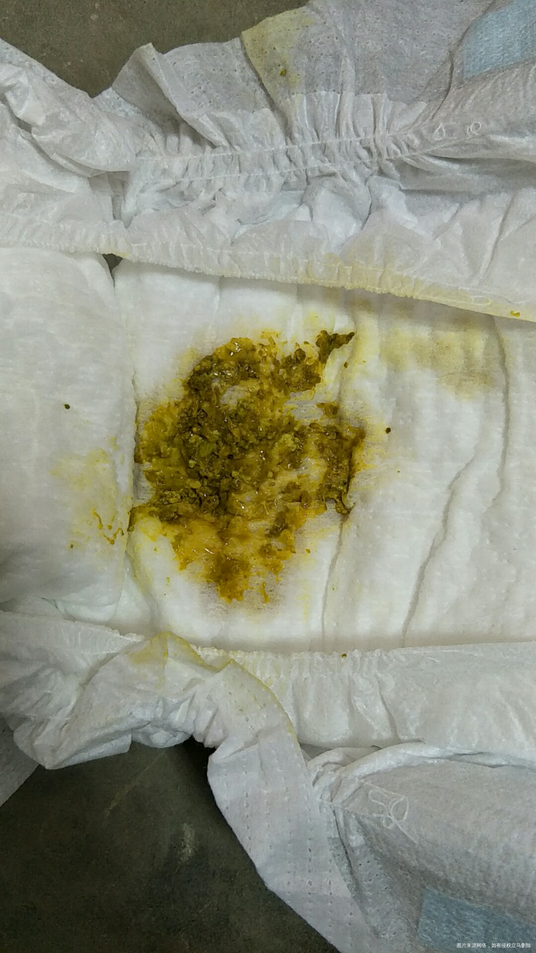 宝宝拉这样的粑粑正常吗