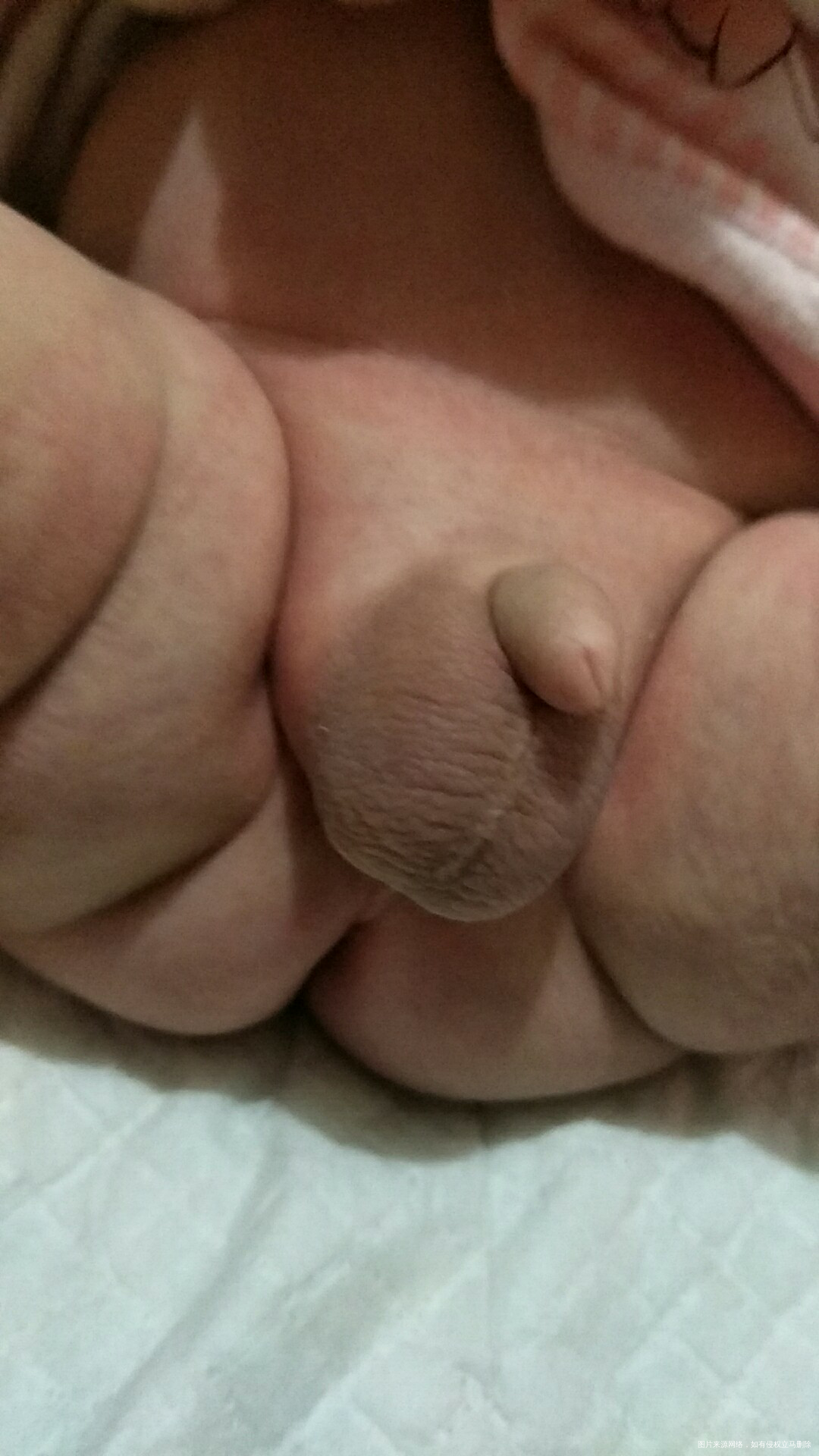 宝宝蛋蛋那里是不是鼓了一个包?