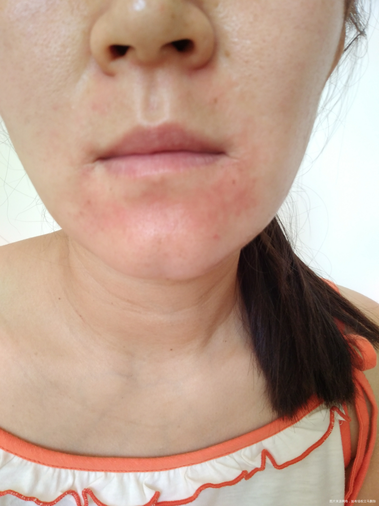 过敏可以吃什么药 脸好痒 急急急急