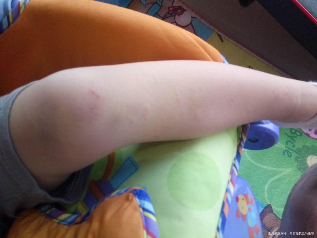 宝宝腿上的痘痘是什么?_?