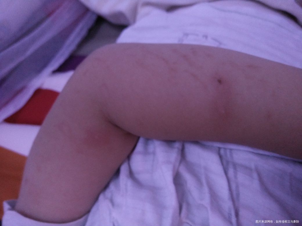 宝宝起的大红疙瘩是怎么回事?