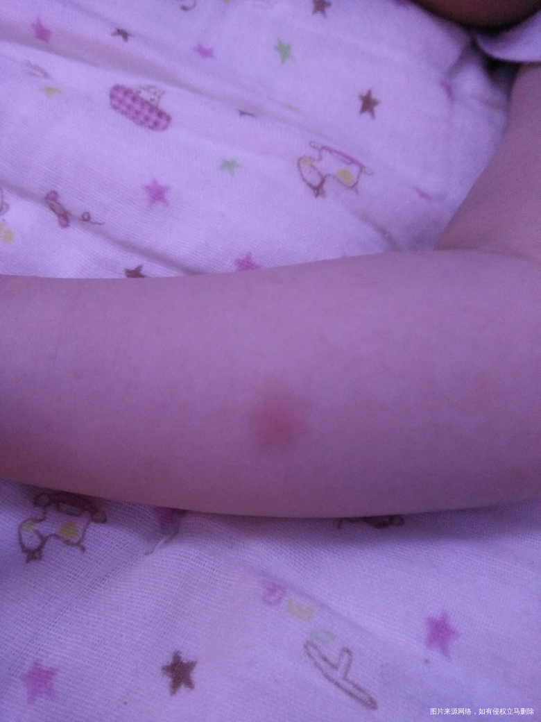 宝宝起的大红疙瘩是怎么回事?