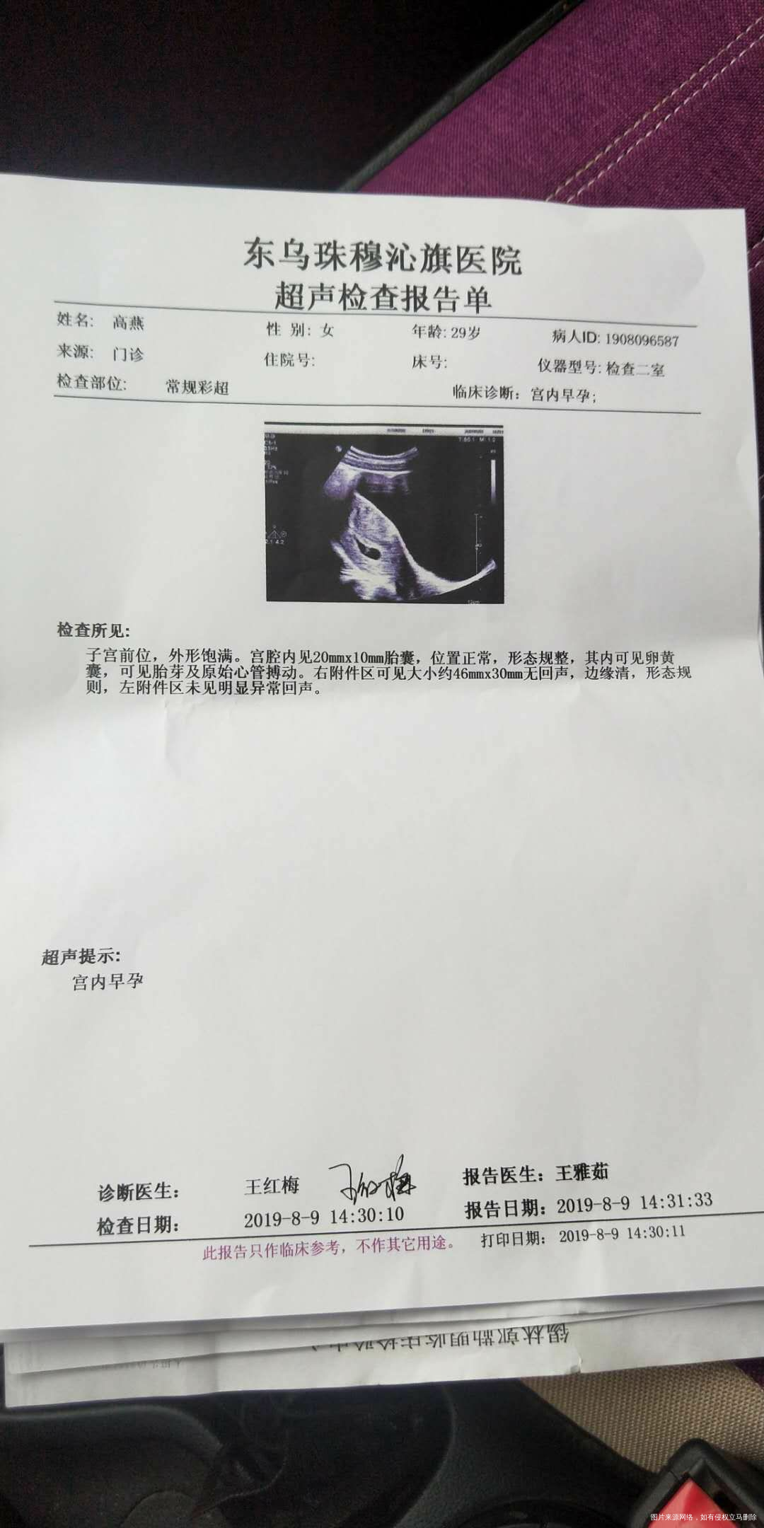 怀孕5周hcg280 孕酮14.3
