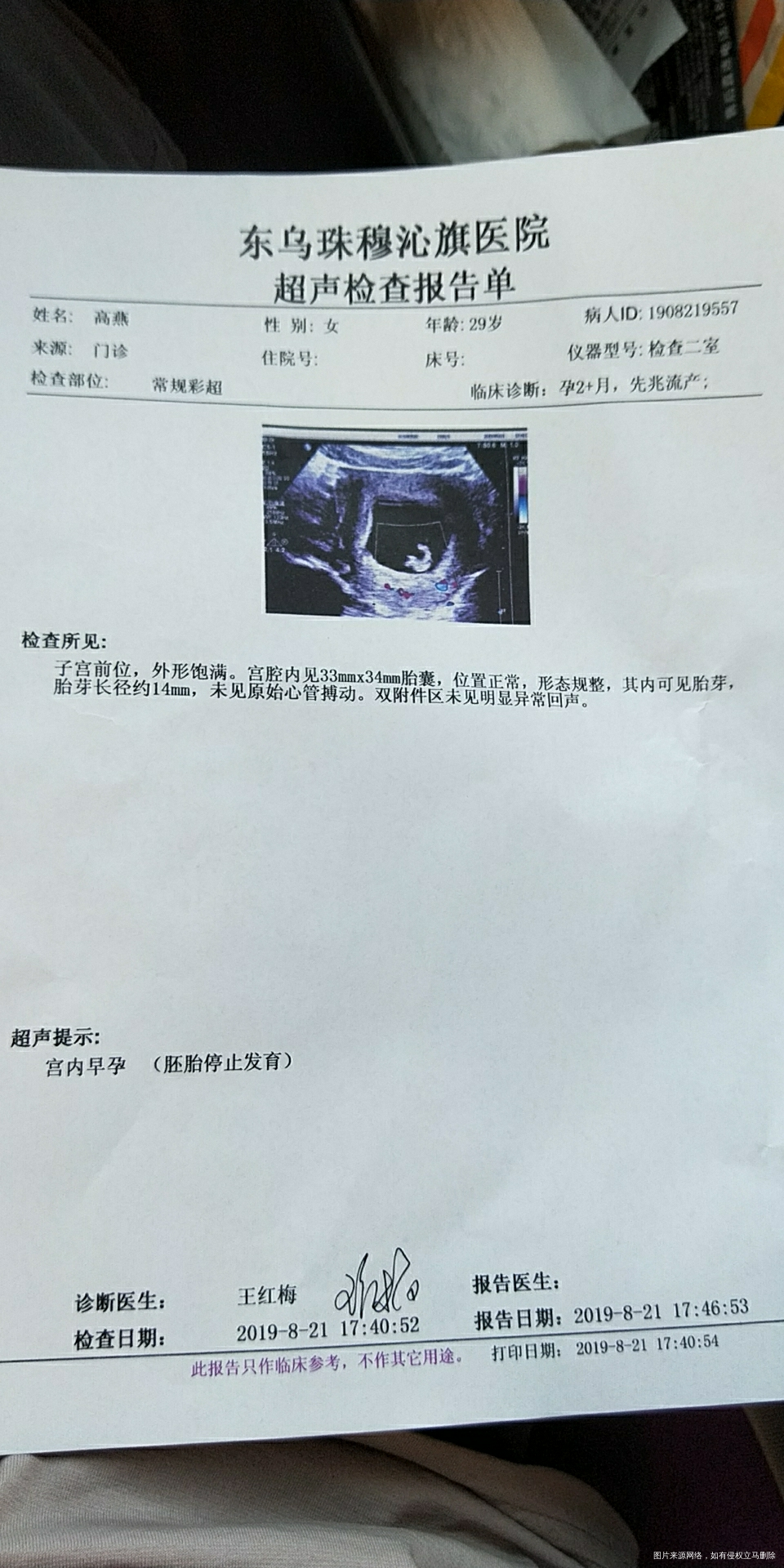 怀孕5周hcg280 孕酮14.3